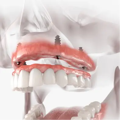 full mouth teeth replacement option